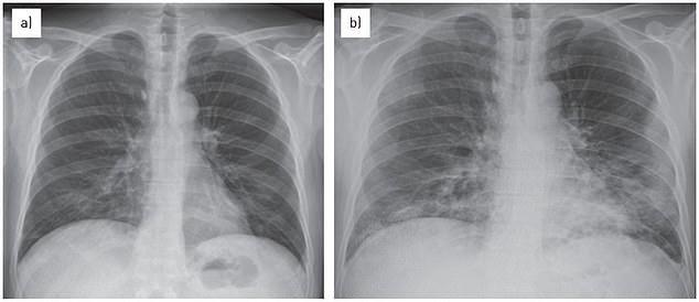 全球肺炎疫情最新動態，全球疫情發展與應對策略解析