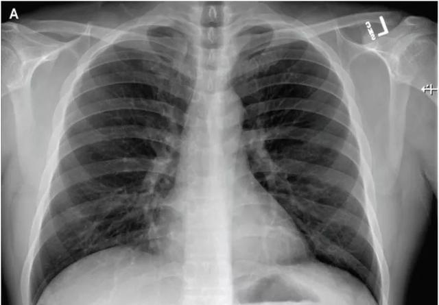 新冠肺炎最新癥狀解析，日常故事中的溫情觀察