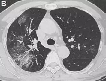 河南新冠病毒最新動態(tài)及防護步驟指南