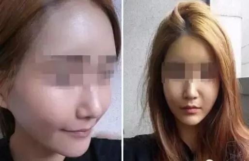 揭秘明星玻尿酸的秘密，美麗背后的真相探索！