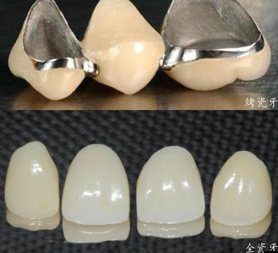 烤瓷牙和全瓷牙價格，探索學習與變化的魅力之旅