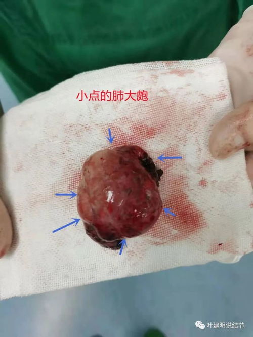 肺大泡最新治療方案的探索與奇妙之旅