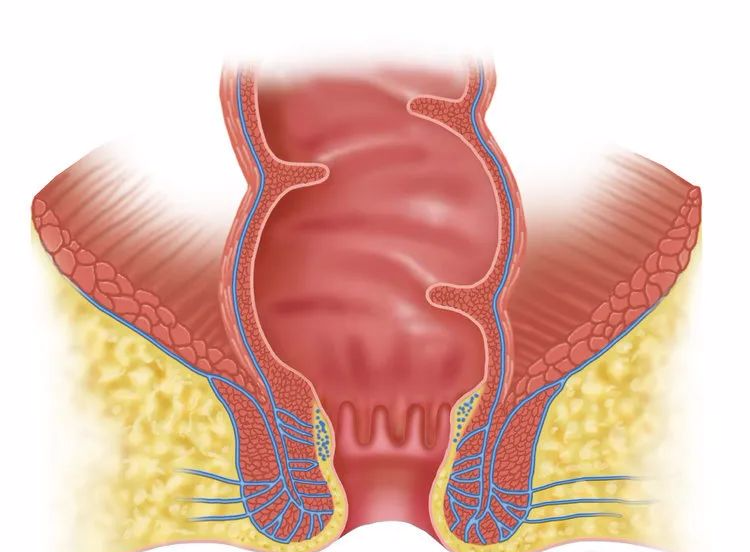 痔瘡手術最新技術介紹與解析