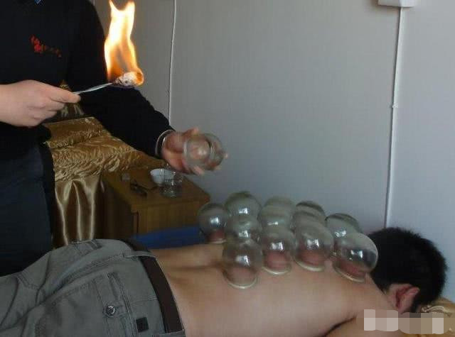 拔罐最新論述,現代演變下的養生方式與觀點碰撞