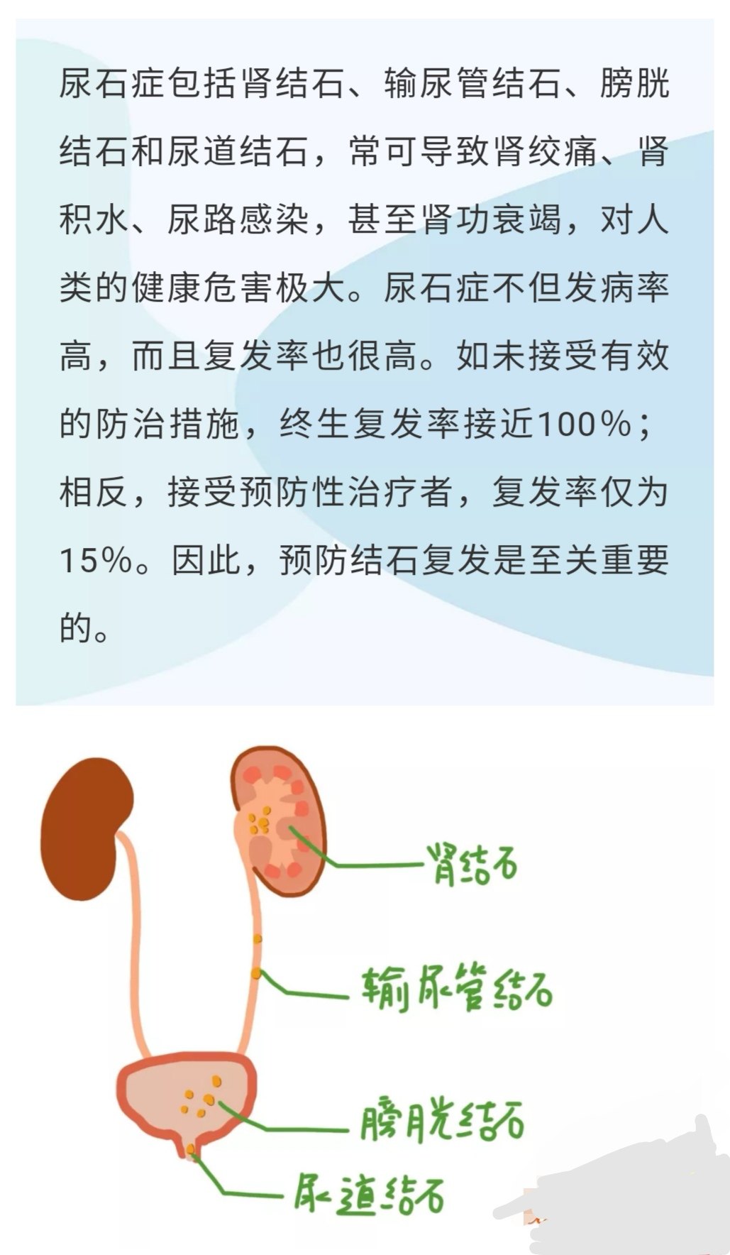 尿結(jié)石最新動(dòng)態(tài),石頭里的溫情日常關(guān)注