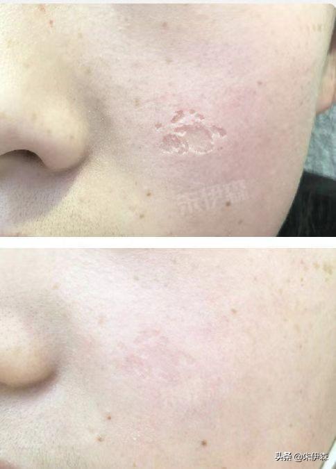 揭秘最新瘢痕治療秘籍，治愈系福音助力瘢痕患者重塑信心?