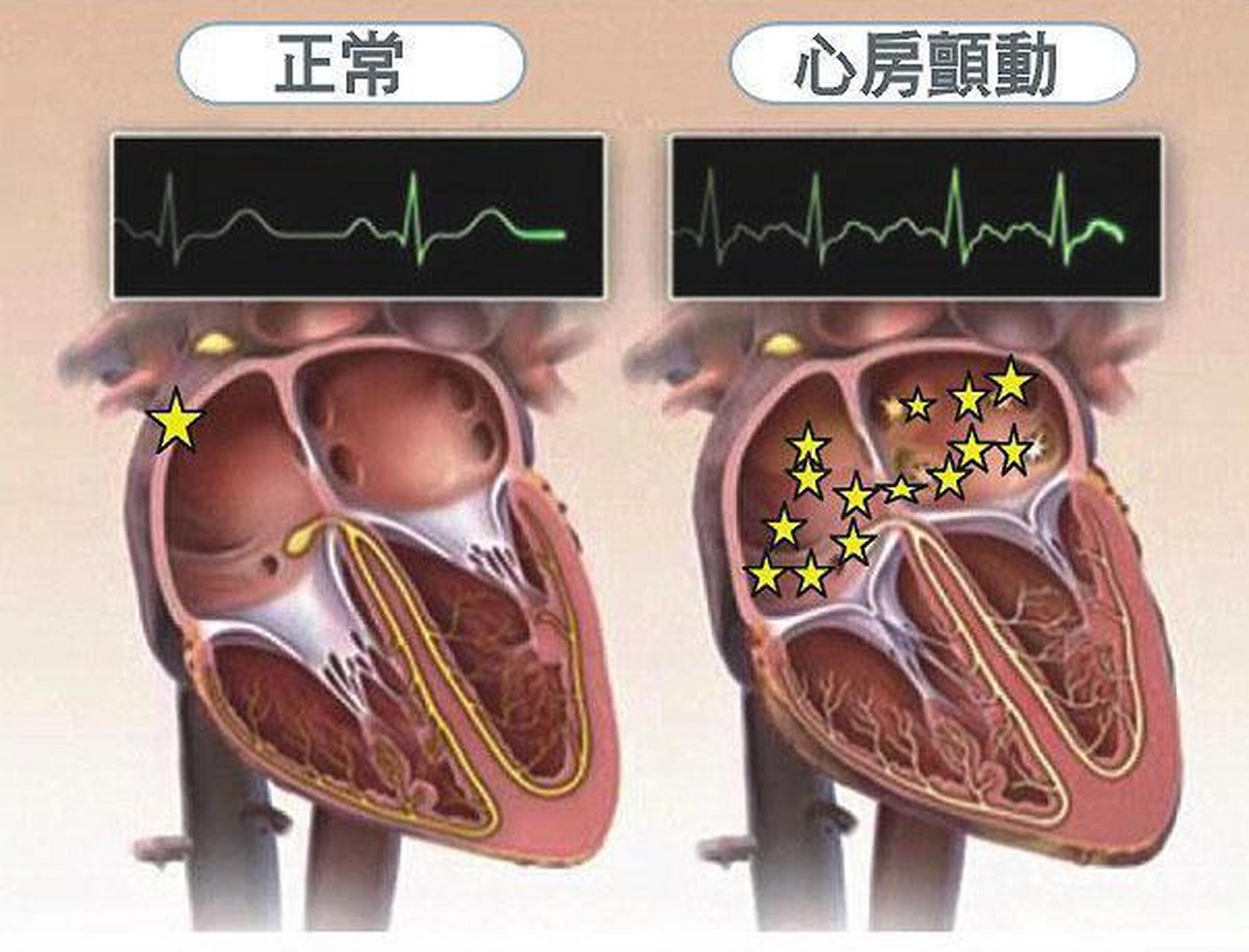 房顫吧最新資訊，全面指南助你應(yīng)對(duì)房顫挑戰(zhàn)