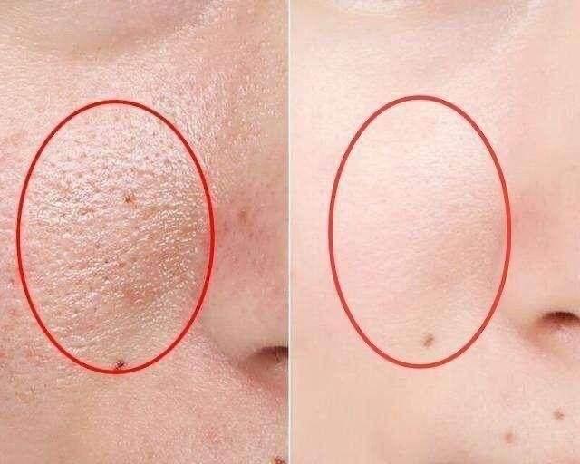 最新除皺科技,重塑自信,煥發新生力量